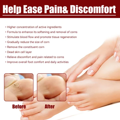 সাউথ মুন ফুট কর্ন রিমুভাল জেল (South Moon Foot Corn Removal Gel)