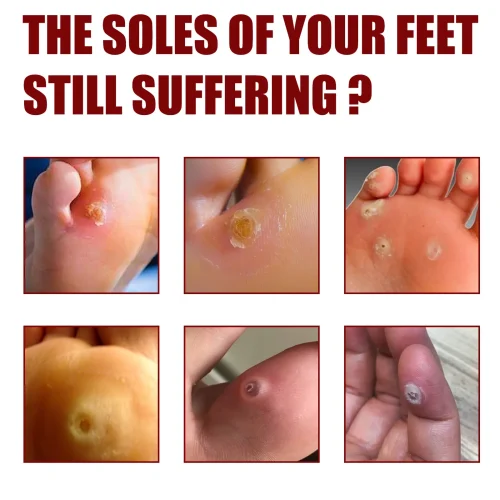 সাউথ মুন ফুট কর্ন রিমুভাল জেল (South Moon Foot Corn Removal Gel)