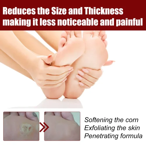 সাউথ মুন ফুট কর্ন রিমুভাল জেল (South Moon Foot Corn Removal Gel)