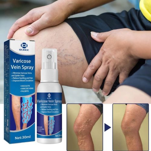 Varicose Vein Spray 30ml পায়ের শিরায় রক্ত সঞ্চালন বাড়ায়, ব্যথা ও ফোলা কমায়